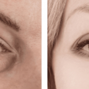 Banish Dark Circles And Puffy Eyes