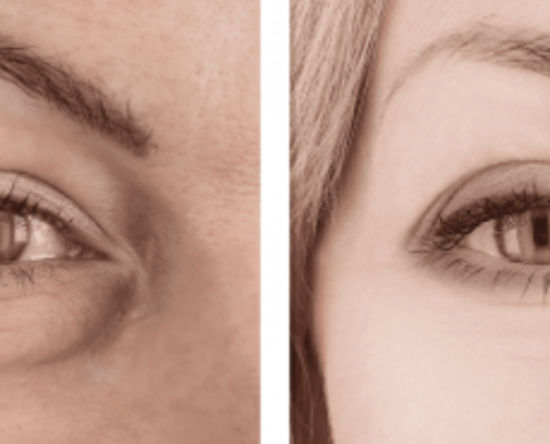 Banish Dark Circles And Puffy Eyes