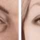 Banish Dark Circles And Puffy Eyes