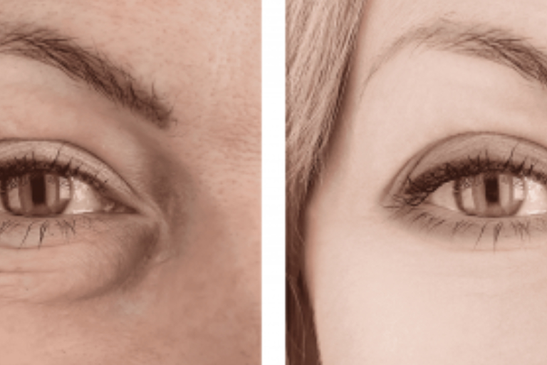 Banish Dark Circles And Puffy Eyes