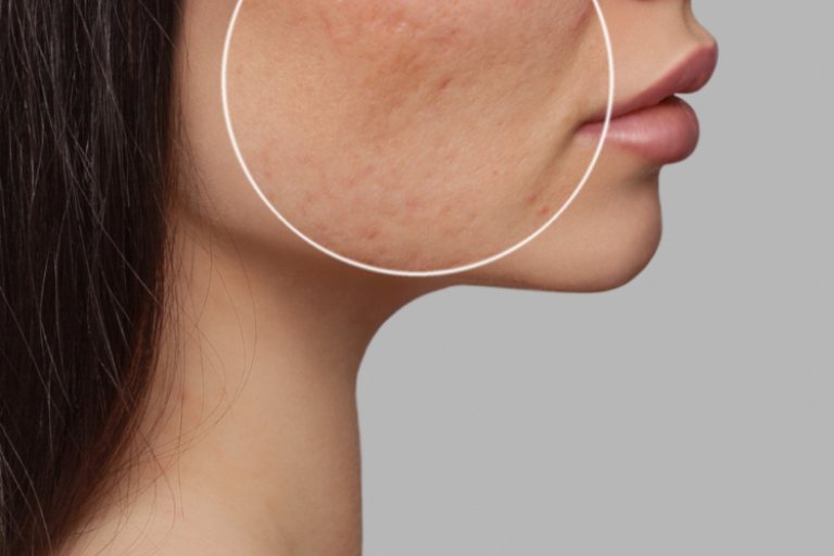 Sunspots, discoloration, and uneven skin tone can leave your skin looking dull, but our team at Bluffton Aesthetics is here to help you achieve a brighter, more even complexion. We understand the impact hyperpigmentation can have on your confidence, and we offer advanced treatments personalized to your unique needs, utilizing state-of-the-art technology to deliver effective results.

Hyperpigmentation occurs when certain areas of the skin produce excess melanin, leading to dark spots or patches. Factors such as sun exposure, aging, hormonal changes, and inflammation can trigger this overproduction.

To combat hyperpigmentation, we offer a variety of in-office treatments, each designed to target specific pigmentation issues and skin types.

For those looking to fade dark spots and sun damage with little to no downtime, IPL treatments are an excellent solution. This treatment uses intense pulsed light to break apart areas of excess pigmentation, allowing the body to gradually clear them away. As an added benefit, IPL also stimulates collagen production, helping to improve overall skin texture and tone. The number of sessions needed varies based on individual skin concerns, but each treatment builds upon the last, revealing clearer and more radiant skin.

A more targeted option for hyperpigmentation involves brightening laser skin resurfacing treatments. These treatments use advanced laser energy to shatter unwanted pigment while triggering the skin’s natural healing response. This method is highly effective for stubborn sunspots, melasma, and post-inflammatory hyperpigmentation. By customizing the intensity of the treatment, dark spots fade while the surrounding skin remains untouched, ensuring a safe and effective outcome with minimal downtime.

Maintaining the results of in-office treatments and preventing future hyperpigmentation requires a diligent at-home skincare routine. Applying our Advanced Power C serum daily can help fade existing dark spots and prevent new ones from forming. Loaded with Vitamin C, a potent antioxidant that inhibits melanin production, this serum protects against UV-induced damage, and promotes collagen production, resulting in brighter, firmer skin.

Achieving and maintaining a bright, even complexion requires a combination of professional treatments and consistent at-home care. Our team will work closely with you to determine the most appropriate treatments for your specific skin concerns and type. We provide personalized recommendations and guide you through the process, ensuring safe and effective results.

In addition to treatments, daily application of broad-spectrum sunscreen is crucial in preventing further hyperpigmentation. Sun exposure is a significant trigger for melanin production, so protecting your skin from UV rays helps maintain the results of your treatments and prevents new dark spots from developing.

Our dedicated team is committed to helping you achieve your skincare goals. If you’re ready to address hyperpigmentation and brighten your complexion, we invite you to schedule a consultation with us. Together, we’ll create a personalized treatment plan tailored to your unique needs, guiding you every step of the way toward healthier, more radiant skin. Book your appointment today.