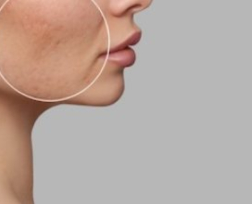 Hyperpigmentation Help: Brighten Up Your Complexion