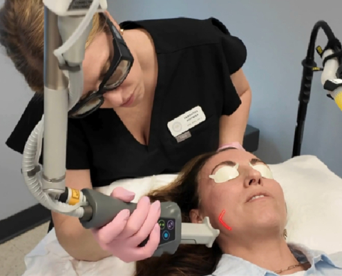 Skin Resurfacing With Helix Coolpeel