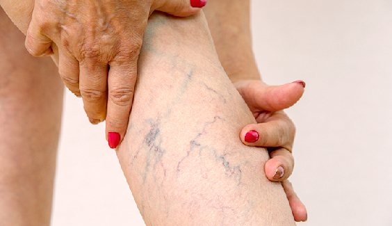 Spider vein treatment with laser at Bluffton Aesthetics