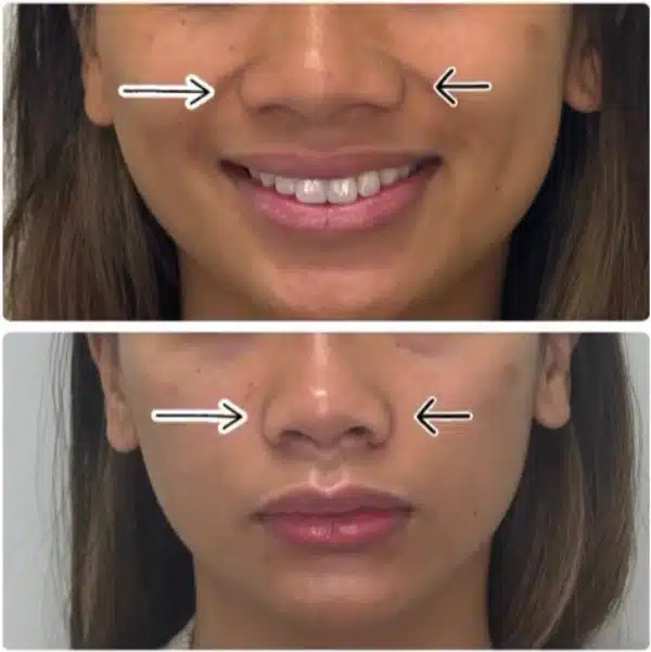 Honolulu nose surgery at Hawaii Facial Plastic Surgery. Before and after rhinoplasty results that look natural and enhance your facial aesthetics.