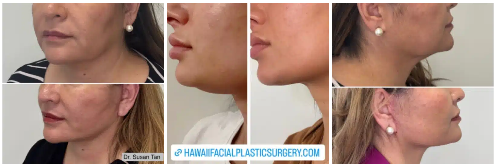 Before and after results of Hawaii neck lifts preformed by Dr. Susan Tan at Hawaii Facial Plastic Surgery. Pacific Island and Asian neck lifts to remove turkey neck and tech neck.