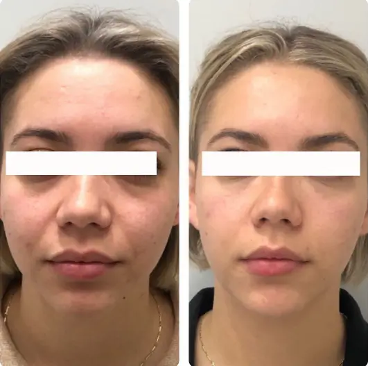 Side-by-side before and after photos of a woman's face with white bars covering her eyes, depicting brow lift and eyelid surgery recovery.