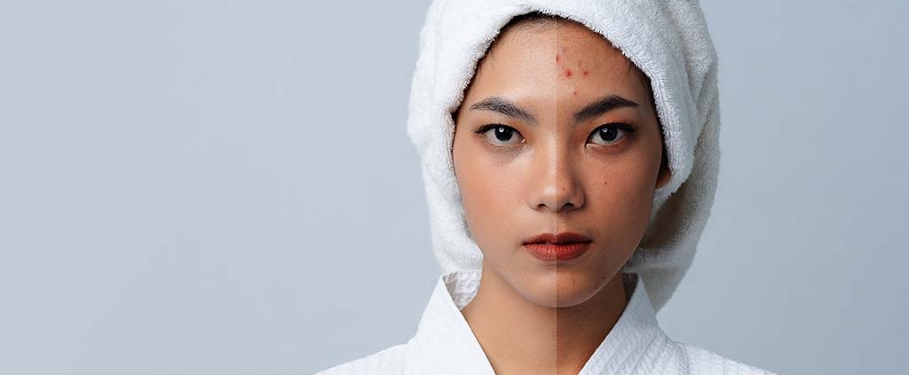 Tips to Make Dermal Filler Last Longer - Dr. Susan Tan