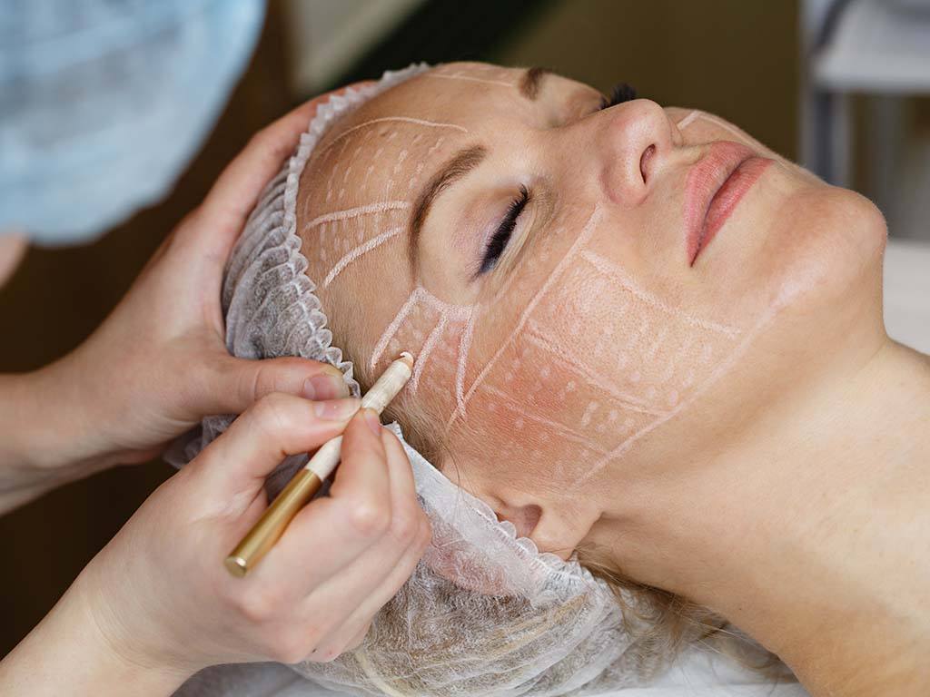 White pencil lines mapped across a relaxed woman's forehead, temple and cheek, the kind of facial planning behind an SMAS or deep plane facelift in Hawaii.