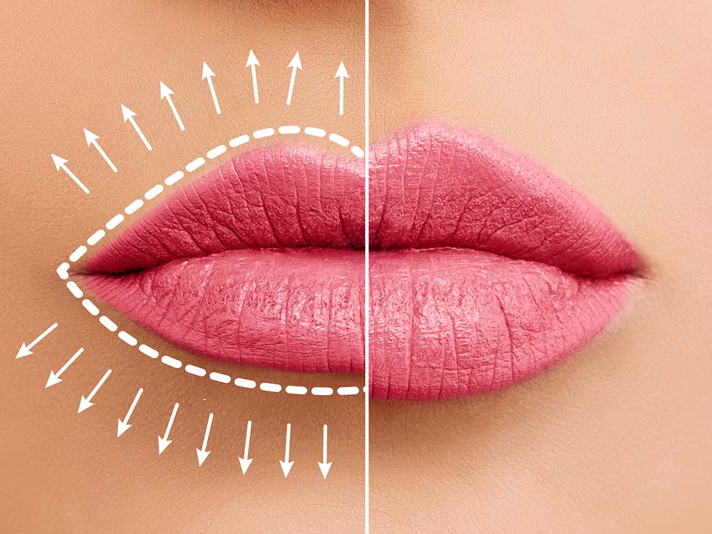 Oahu lip filler treatment, Honolulu. Add volume to lips with Dr. Susan Tan.