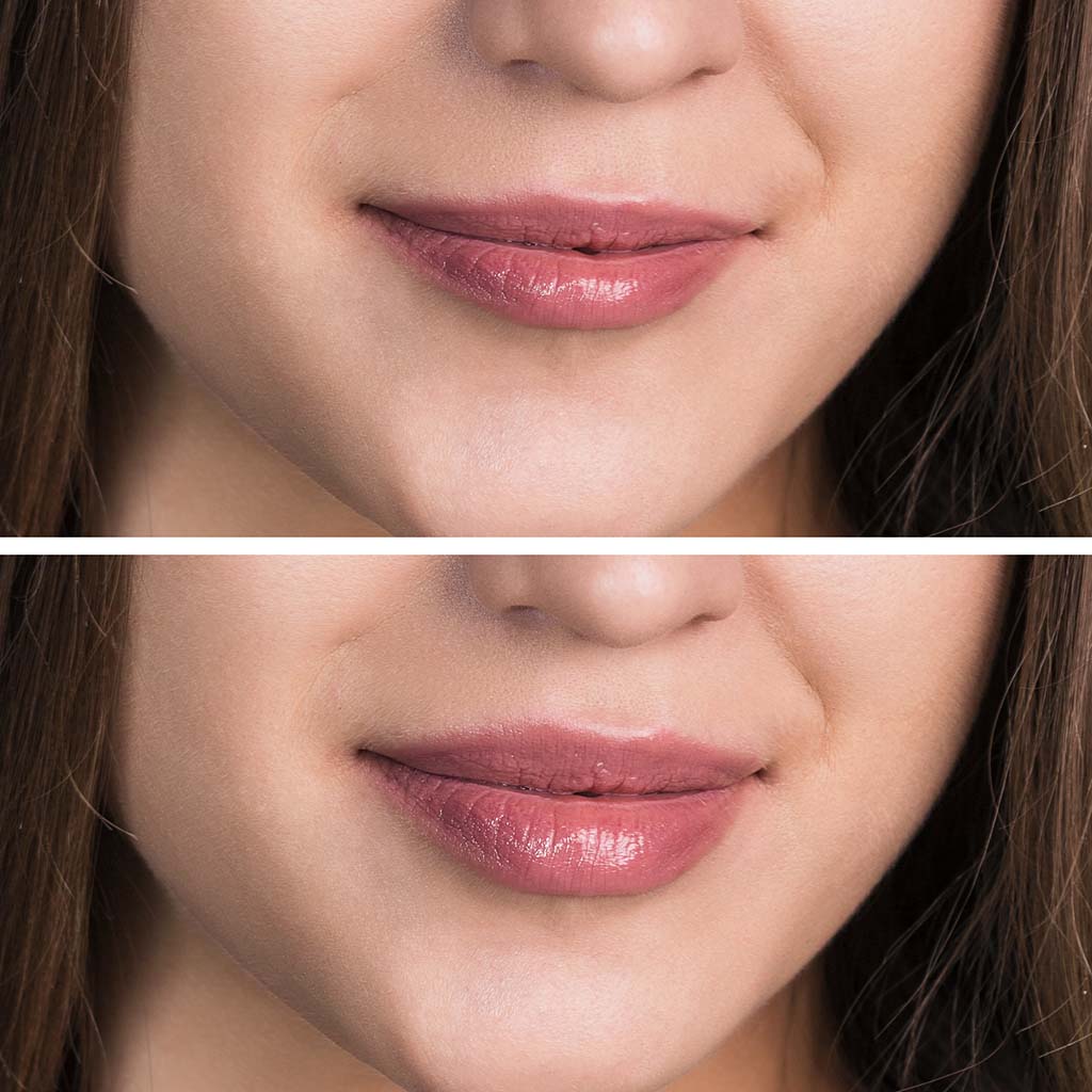 Hawaii lip fill treatment, Honolulu. Lip augmentation before and after.