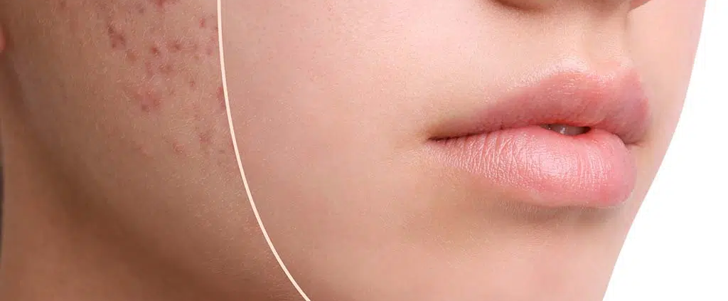 Before and after results of laser acne peel, Honolulu. Treatment for acne scarring, Hawaii.