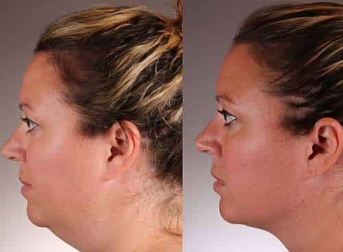 Hollywood spectra short-pulse laser to treat melasma and other skin conditions, Honolulu HI. Skin treatment laser.