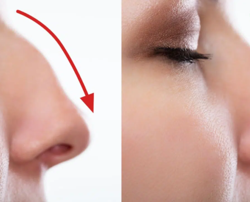 What I Wish I Knew Before Rhinoplasty - Dr. Susan Tan