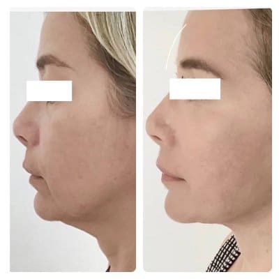 Side profile before and after of a blonde woman: loose skin under the chin and a soft jawline look tighter, common deep plane facelift concerns.