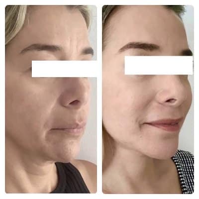 Angled before-and-after of a blonde woman: her smile lines, jowls and jawline look softer and more defined, the refreshed look Hawaii patients want.