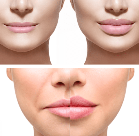 Oahu HIFU procedure vs. Botox and dermal filler injections. Honolulu HIFU lifts and firms skin and eliminates wrinkles.