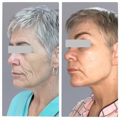 Traditional vs. deep plane facelift topic: side-by-side photos of a gray-haired woman whose creased cheeks and sagging jawline look lifted afterward.