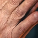 Close-up of deeply wrinkled and crepey skin on an older hand, illustrating the clear need for effective hand rejuvenation to restore youth.