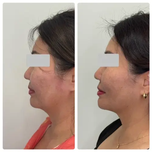 Ultherapy Prime skin tightening, left profile, patient in her 40s, lower face aging and jawline, 6 months follow-up, case 1