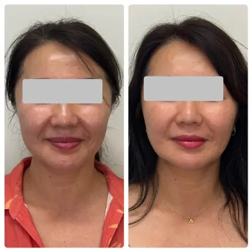 Ultherapy Prime skin tightening, front view, patient in her 40s, lower face aging and jawline, 6 months follow-up, case 1