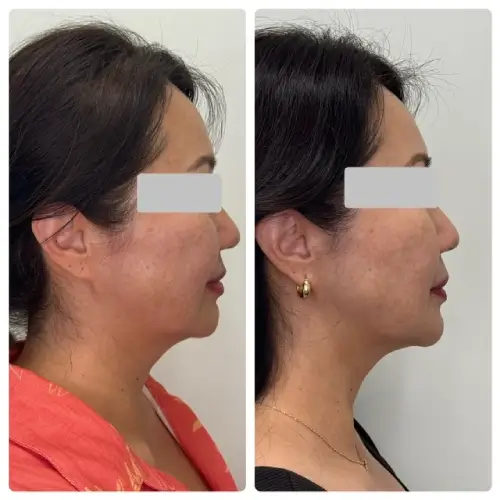 Ultherapy Prime skin tightening, right profile, patient in her 40s, lower face aging and jawline, 6 months follow-up, case 1