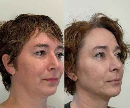 Ultherapy Prime skin tightening, right oblique, patient in her 40s, lower face aging and jawline, 6 months follow-up, case 2