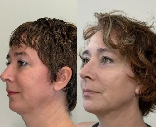 Ultherapy Prime skin tightening, left oblique, patient in her 40s, lower face aging and jawline, 6 months follow-up, case 2