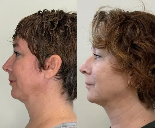 Ultherapy Prime skin tightening, left profile, patient in her 40s, lower face aging and jawline, 6 months follow-up, case 2