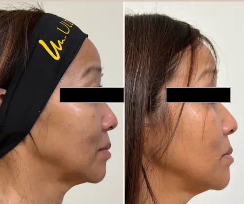 Ultherapy Prime skin tightening, right profile, patient in her 50s, lower face aging and jawline, 6 months follow-up, case 3