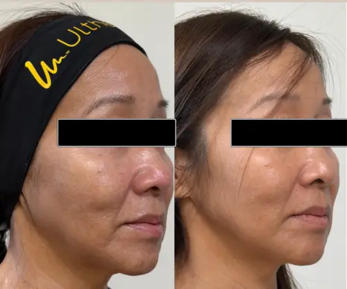 Ultherapy Prime skin tightening, right oblique, patient in her 50s, lower face aging and jawline, 6 months follow-up, case 3