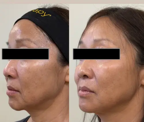 Ultherapy Prime skin tightening, left oblique, patient in her 50s, lower face aging and jawline, 6 months follow-up, case 3