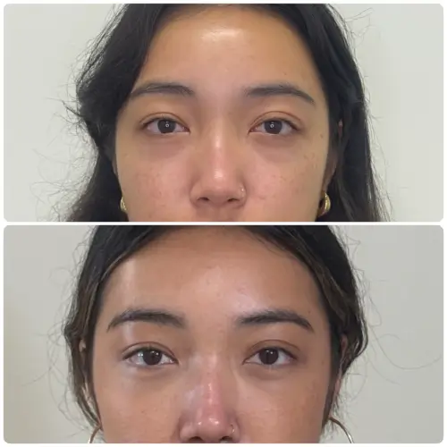 Transconjunctival lower blepharoplasty, front view, patient in her 20s, 2 months post-op, case 1
