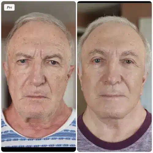 Deep plane facelift and neck lift, front view, patient in his 70s, 6 months post-op, case 7