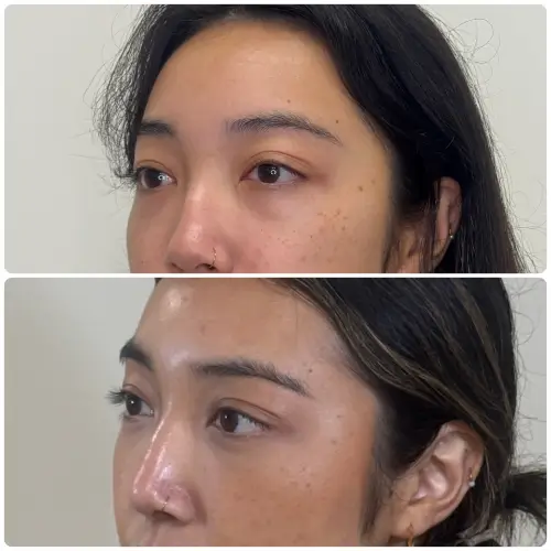 Transconjunctival lower blepharoplasty, left oblique, patient in her 20s, 2 months post-op, case 1