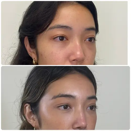 Transconjunctival lower blepharoplasty, right oblique, patient in her 20s, 2 months post-op, case 1