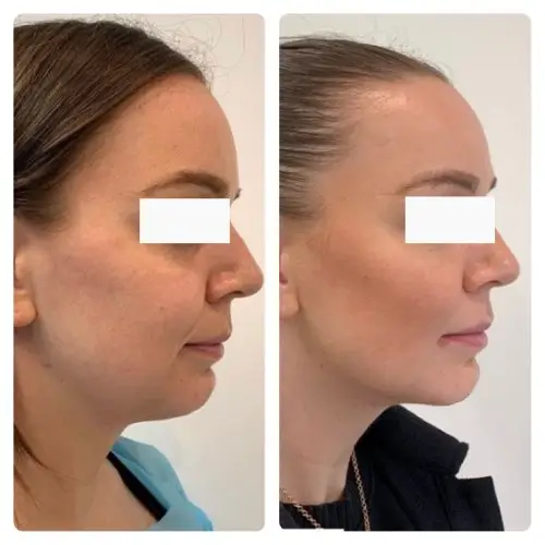 Neck liposuction, right profile, 1 year post-op, case 3