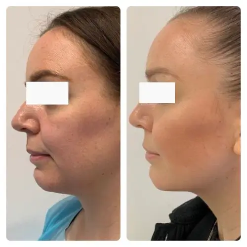 Neck liposuction, left profile, 1 year post-op, case 3