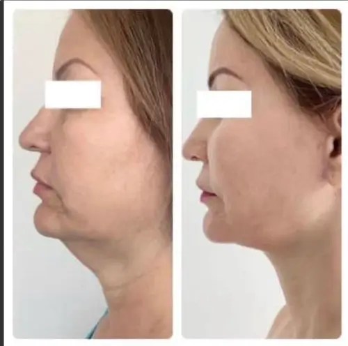 Deep plane facelift and neck lift, left profile, patient in her 60s, 1 year post-op, case 5