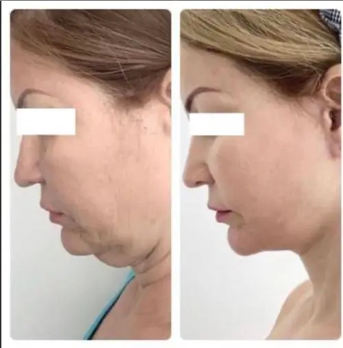 Deep plane facelift and neck lift, left profile, head down, patient in her 60s, 1 year post-op, case 5