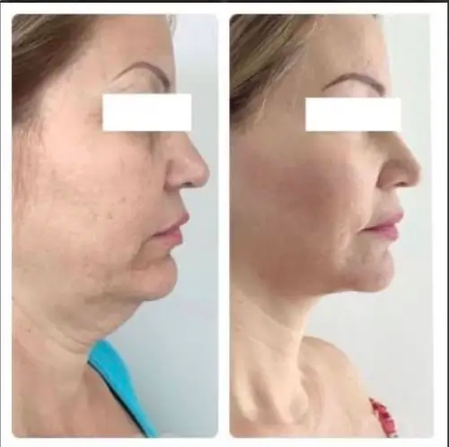 Deep plane facelift and neck lift, right profile, patient in her 60s, 1 year post-op, case 5