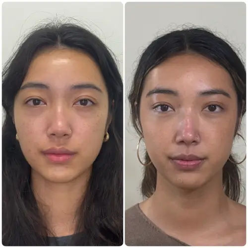 Revision rhinoplasty, front view, patient in her 20s, saddle nose deformity with rib cartilage reconstruction, 2 months post-op, case 10