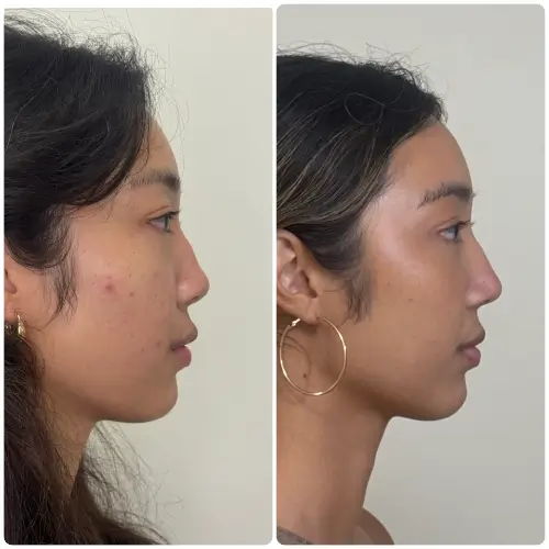 Revision rhinoplasty, right profile, patient in her 20s, saddle nose deformity with rib cartilage reconstruction, 2 months post-op, case 10