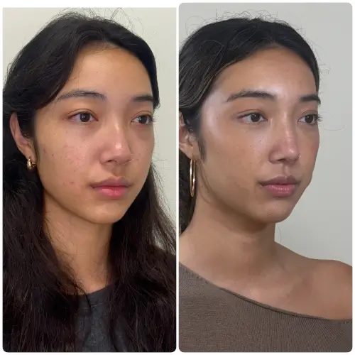 Revision rhinoplasty, right oblique, patient in her 20s, saddle nose deformity with rib cartilage reconstruction, 2 months post-op, case 10