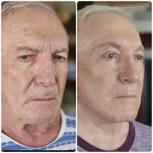 Deep plane facelift and neck lift, right oblique, patient in his 70s, 6 months post-op, case 7