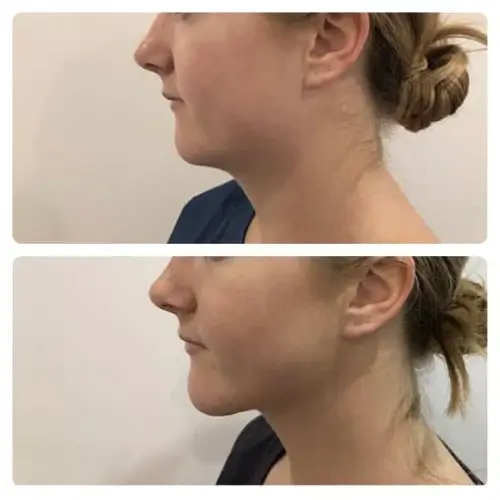 Neck liposuction, left profile, 6 months post-op, case 5