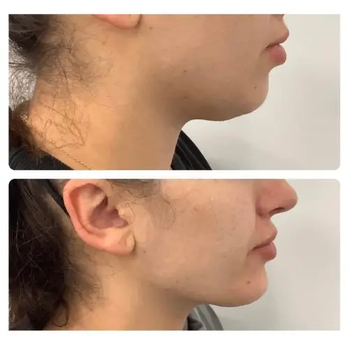 Neck liposuction, right profile, 6 months post-op, case 5