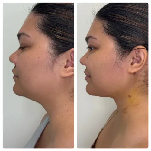 Neck liposuction and buccal fat removal, left profile, patient in her 20s, 1 week post-op, case 1