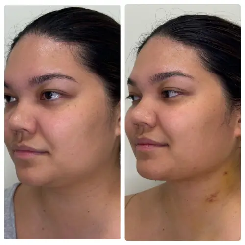 Neck liposuction and buccal fat removal, left oblique, patient in her 20s, 1 week post-op, case 1