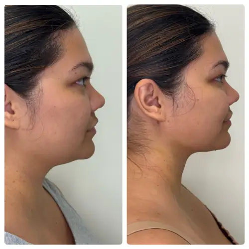 Neck liposuction and buccal fat removal, right profile, patient in her 20s, 1 week post-op, case 1